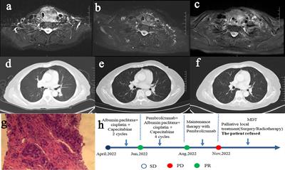 Case report: The impact of dissociated response of immunotherapy on the treatment strategy of advanced head and neck cancer